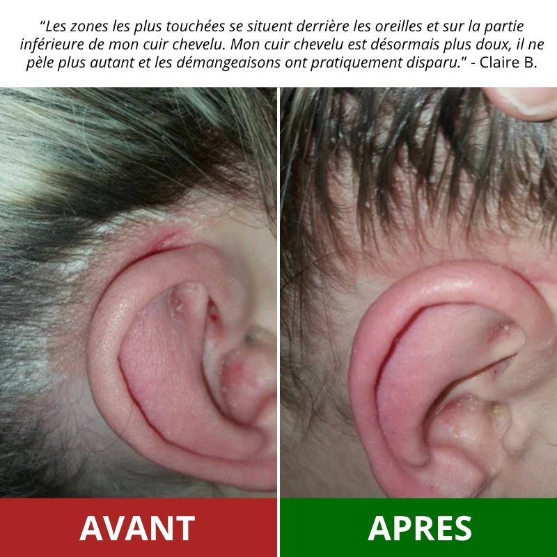 Gommage cuir chevelu